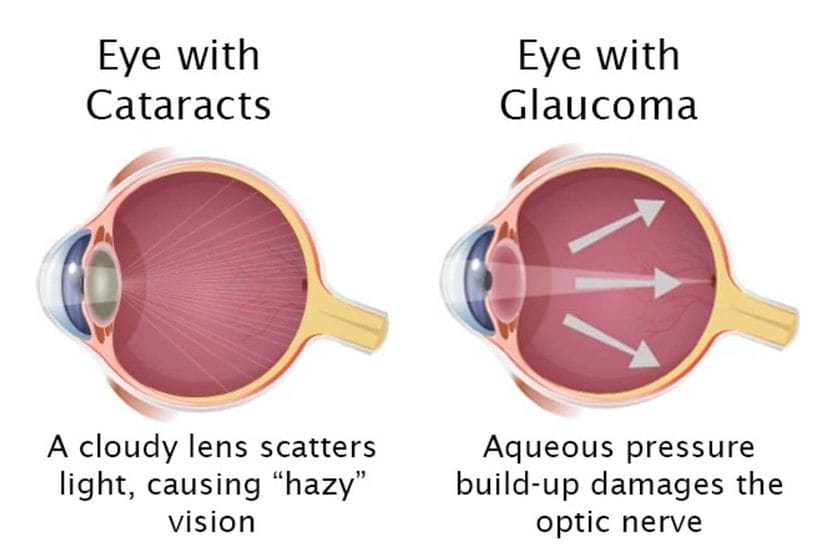 Glaucoma vs. cataracts Depiction of a cataract v glaucoma