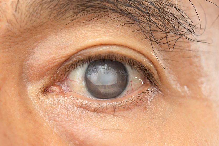 Close-up image of a man's eye with an untreated cataract.