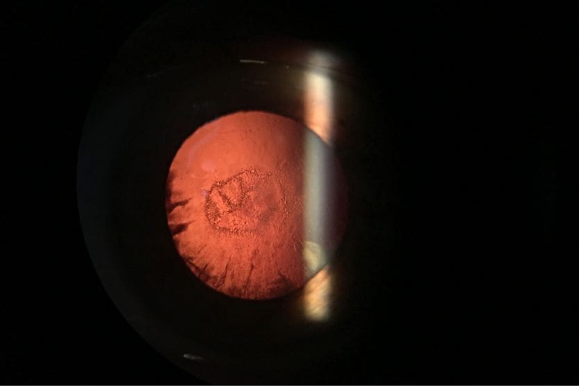 Posterior subcapsular cataract
