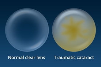 Traumatic cataracts: Causes, symptoms and treatment