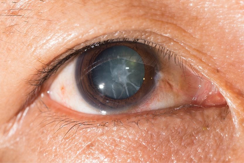 Traumatic cataracts: Causes, symptoms and treatment closeup of an eye with a traumatic cataract