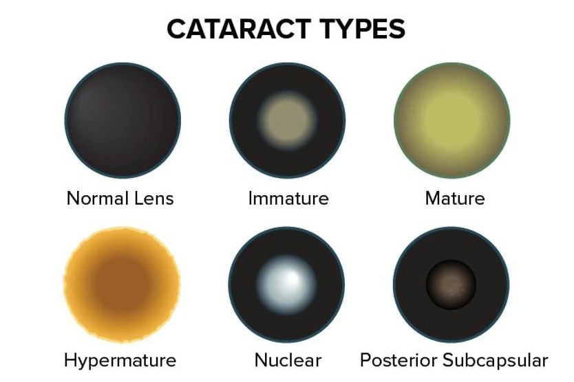 illustration of the different types of cataracts