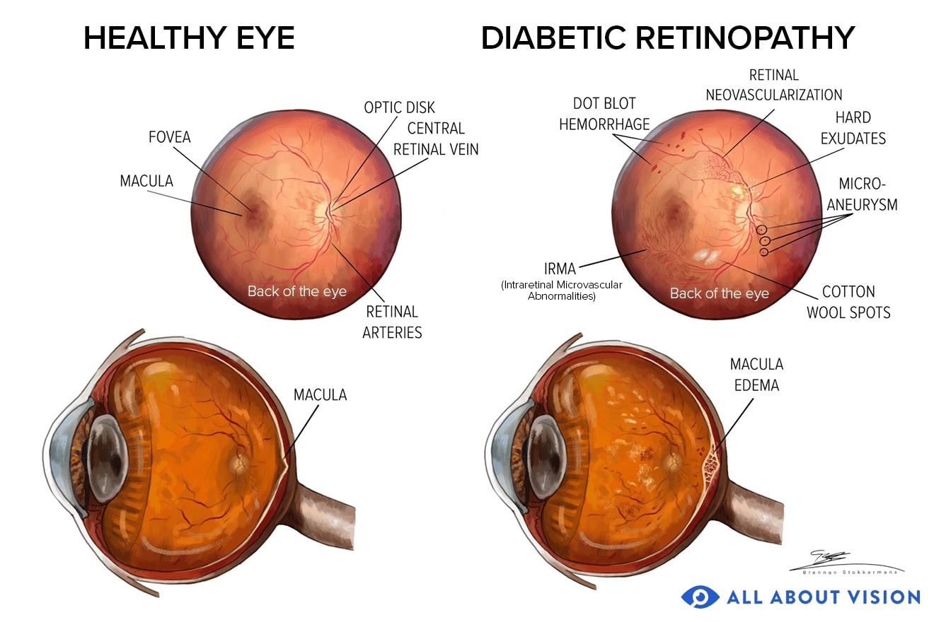 Diabetic retinopathy
