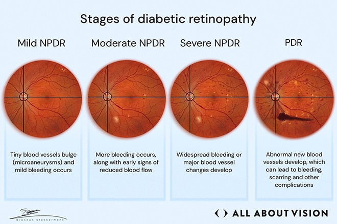 How diabetic retinopathy can lead to macular edema Illustration comparing diabetic retinopathy stages, showing retinal changes that can lead to diabetic macular edema.