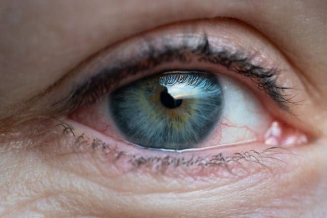 Dry eyes: Symptoms and causes