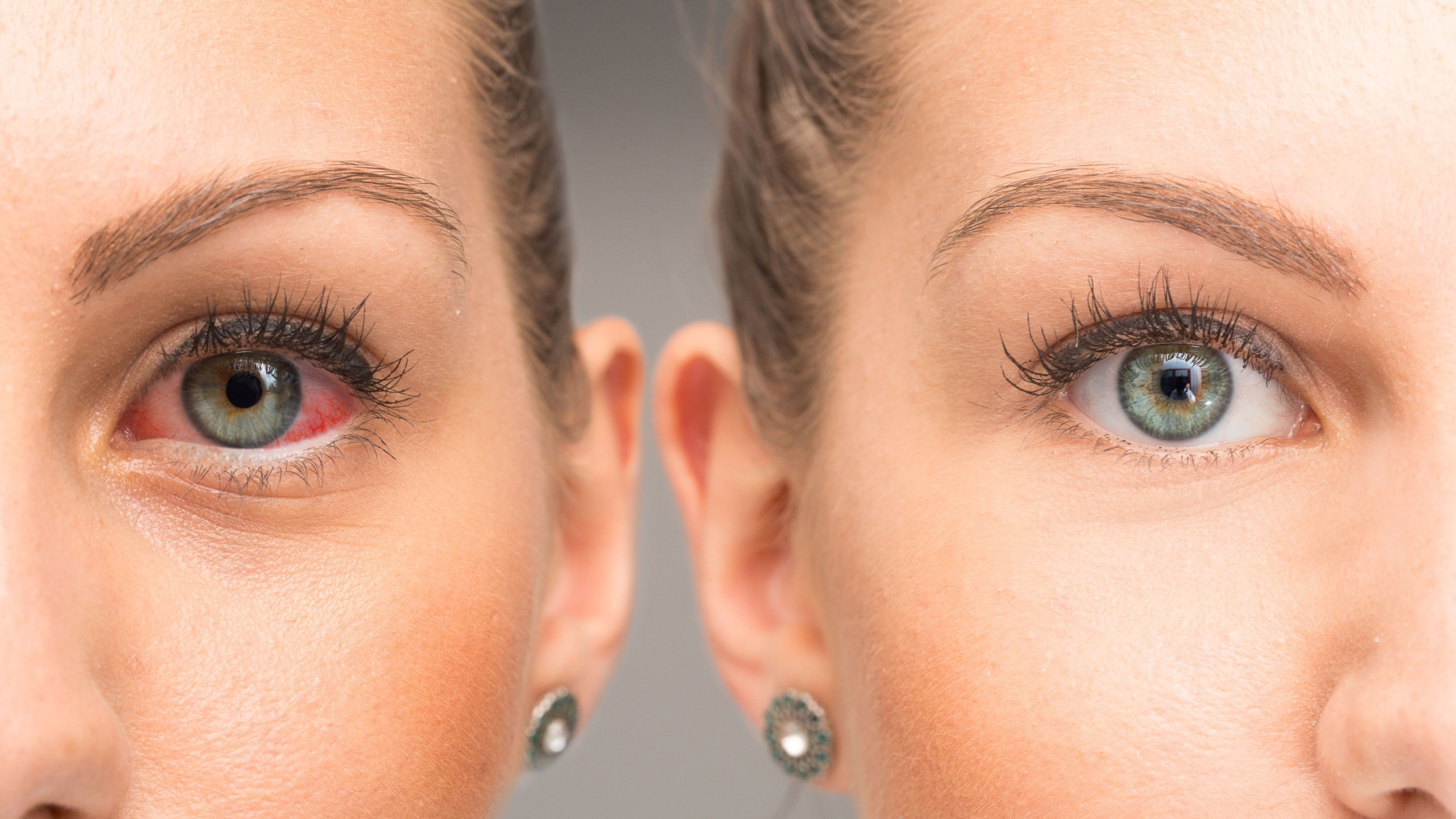 side by side image of normal eye vs dry eye