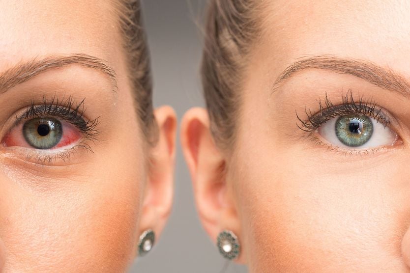 side by side image of normal eye vs dry eye
