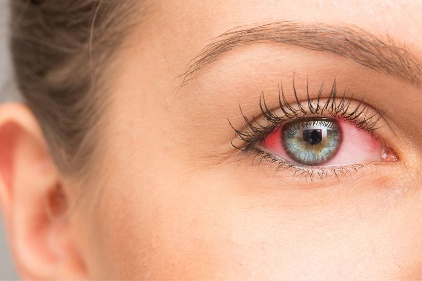 Dry eye treatment: How to soothe irritated eyes Red, dry eyes