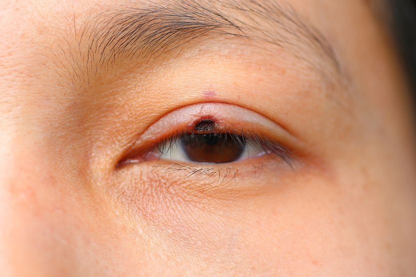 closeup of a person with possible eyelid cancer