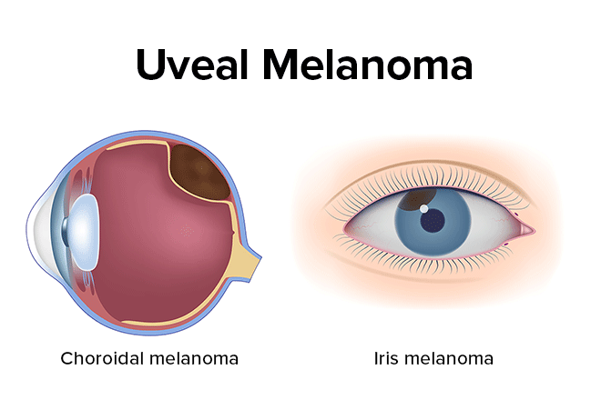 Ocular melanoma