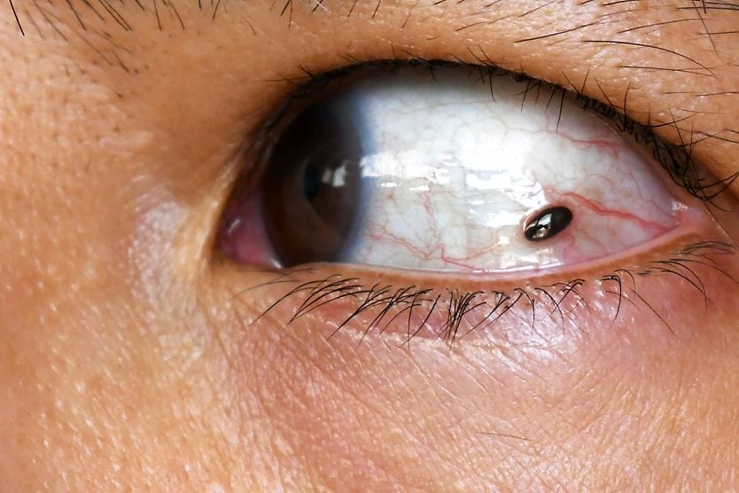 closeup of a woman's eye with ocular melanoma