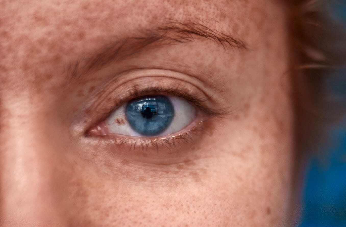 melanotic patch Mystery behind labial and oral macules: Clinical, dermoscopic and pathological aspects of Laugier-Hunziker syndrome Oral Melanotic Macule: a small