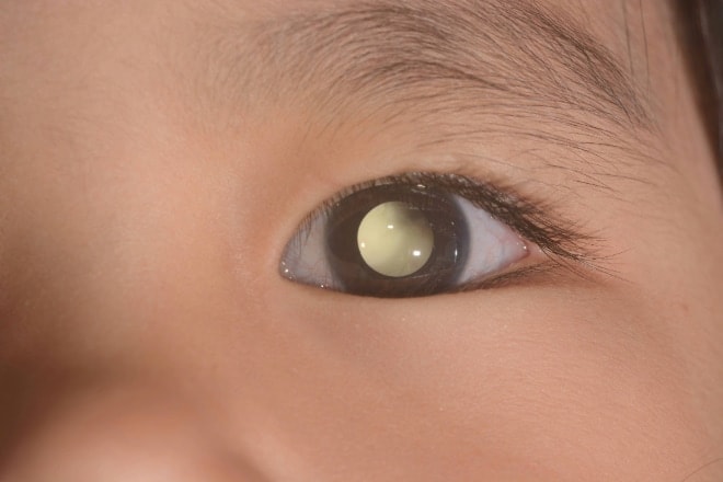 Retinoblastoma