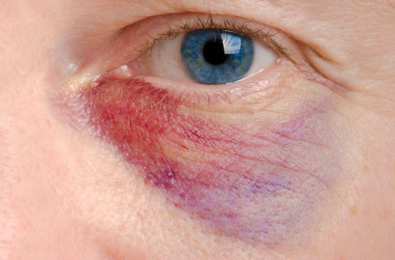 Patient with gauze over eye