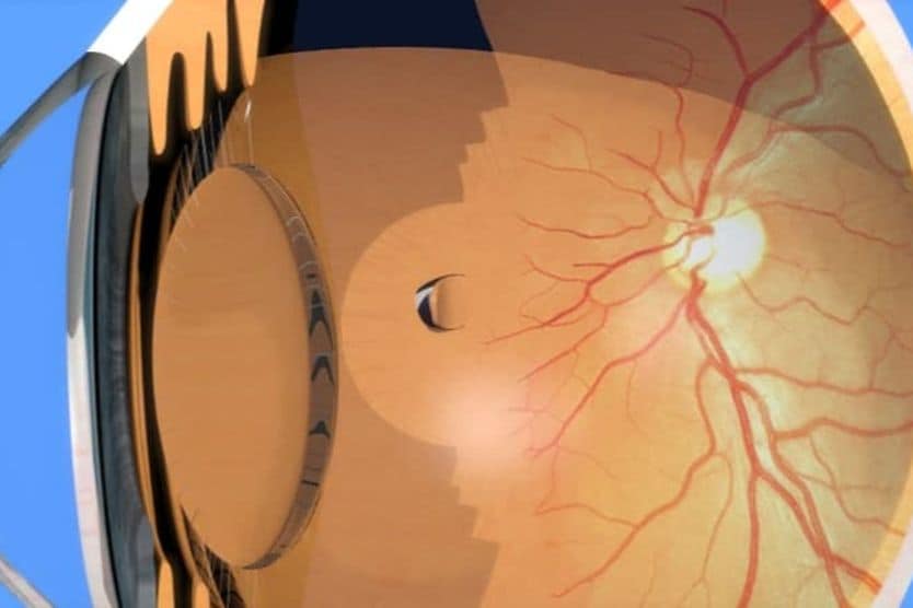 Retinal tears: Symptoms and causes Rendering of a retinal tear