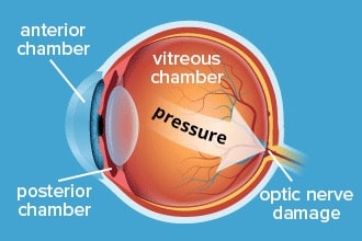 Glaucoma causes: What we know about intraocular pressure (IOP) and optic nerve damage