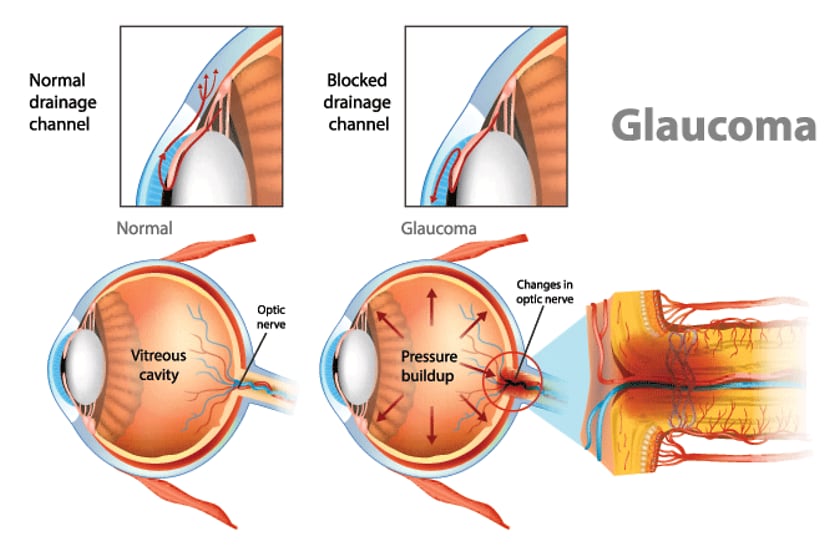 Illustration showing open-angle glaucoma. Intraocular pressure in the back of the eye.