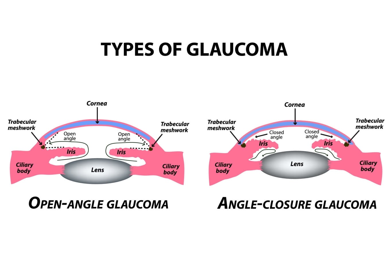 Secondary glaucoma: Causes, symptoms, types and treatment Secondary glaucoma: Causes, symptoms, types and treatment