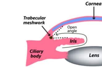 Secondary glaucoma: Causes, symptoms, types and treatment Secondary glaucoma: Causes, symptoms, types and treatment