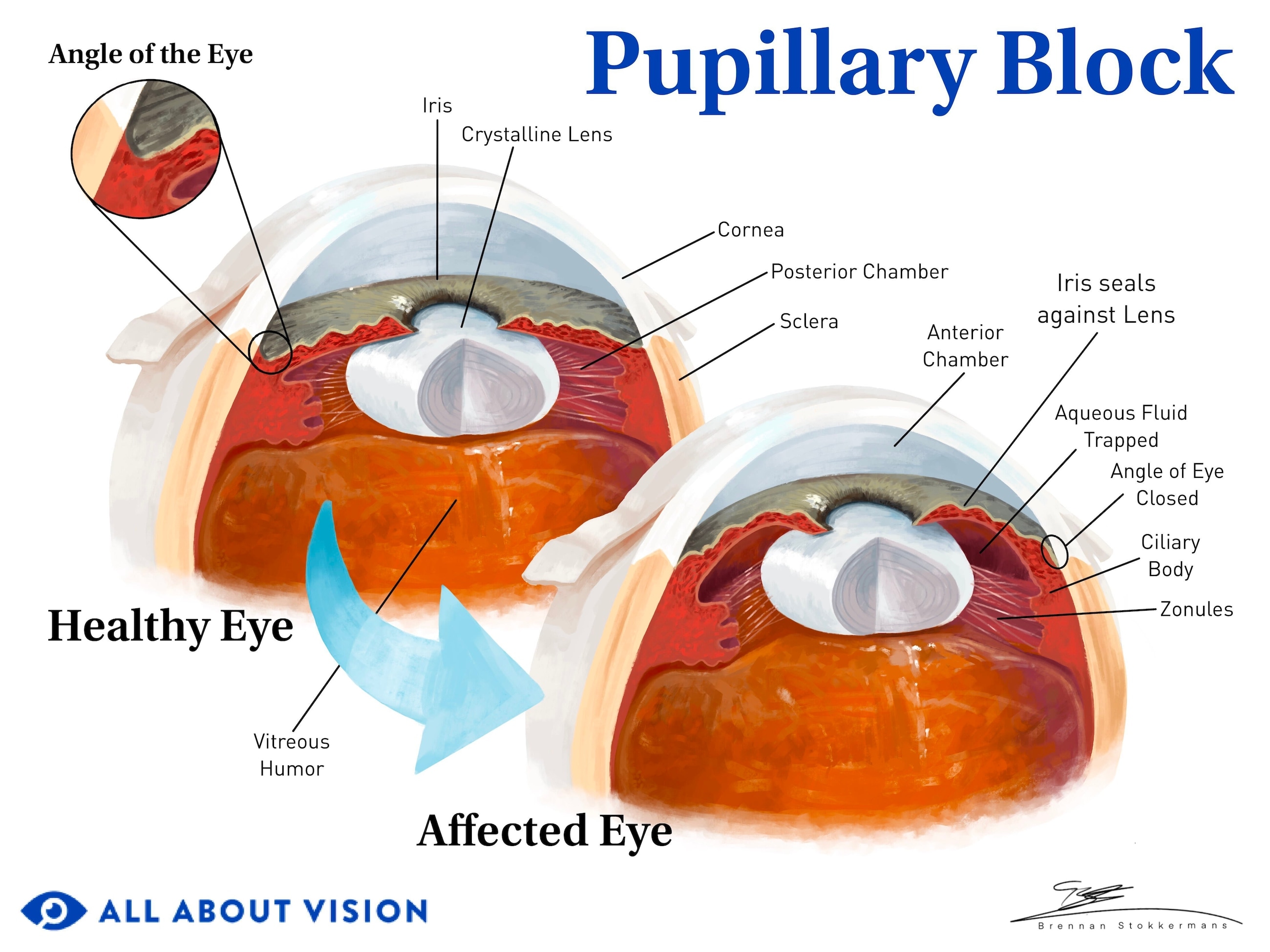 Secondary glaucoma: Causes, symptoms, types and treatment Secondary glaucoma: Causes, symptoms, types and treatment