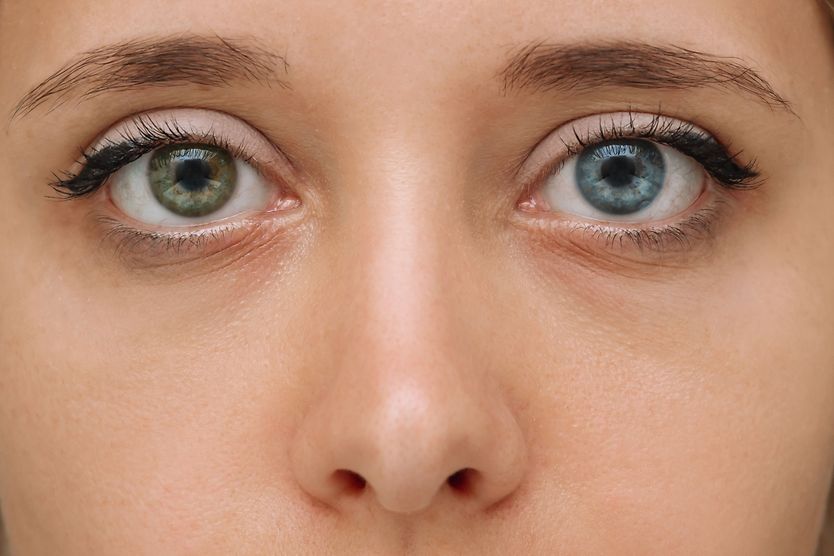 Heterochromia close up of woman illustration of an eyeball and genetic dna