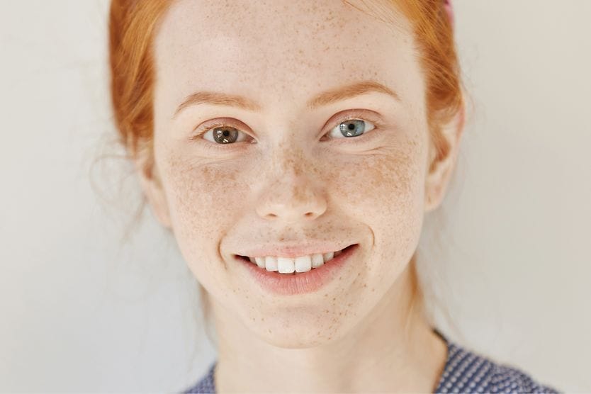 Heterochromia is having different-colored eyes Girl with heterochromia
