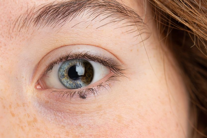 What is partial heterochromia? closeup of a woman's eye with partial or sectoral heterochromia