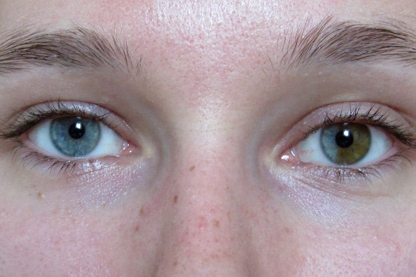 Types of heterochromia closeup of sectoral or segmental heterochromia eyes