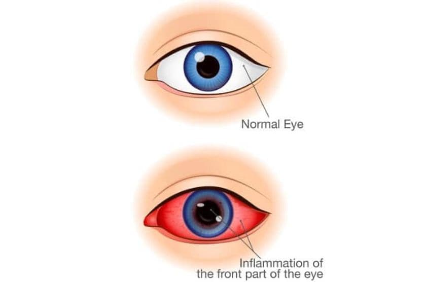 What is anterior uveitis and what causes it? Comparison between eyes that have the symptoms of anterior uveitis and normal eyes.