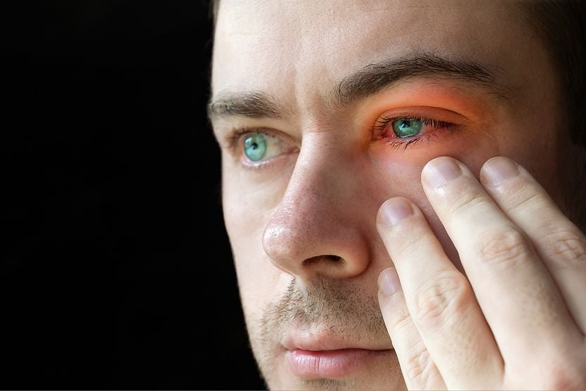 Types of bug bites on the eyelid Red eyes and irritation can occur after a bug bite.