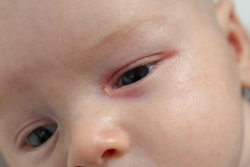 infant with canaliculitis