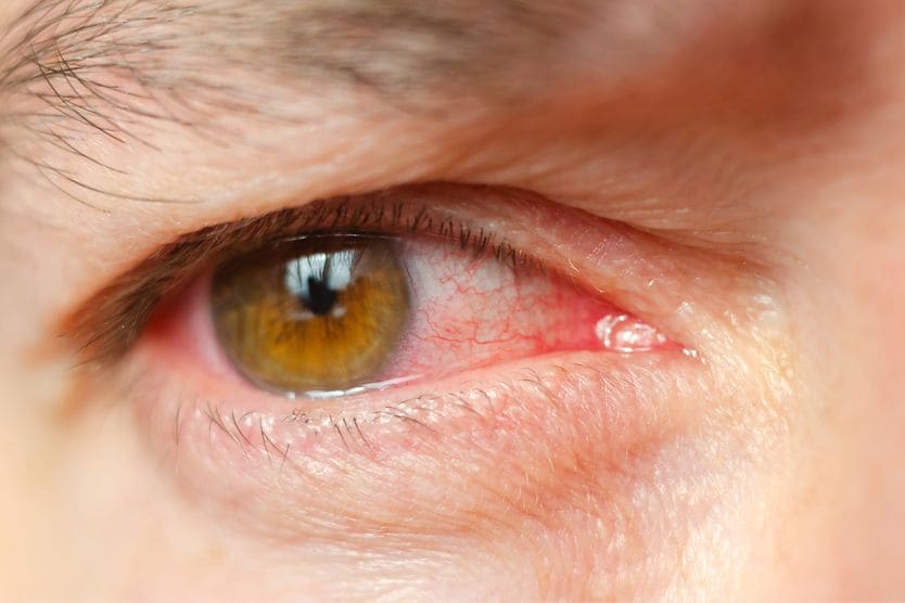 Irritated eye due to an infection