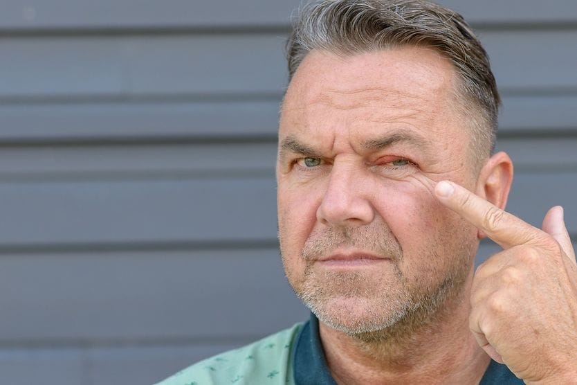 A man looks unhappy as he points to a bump on his eyelid.