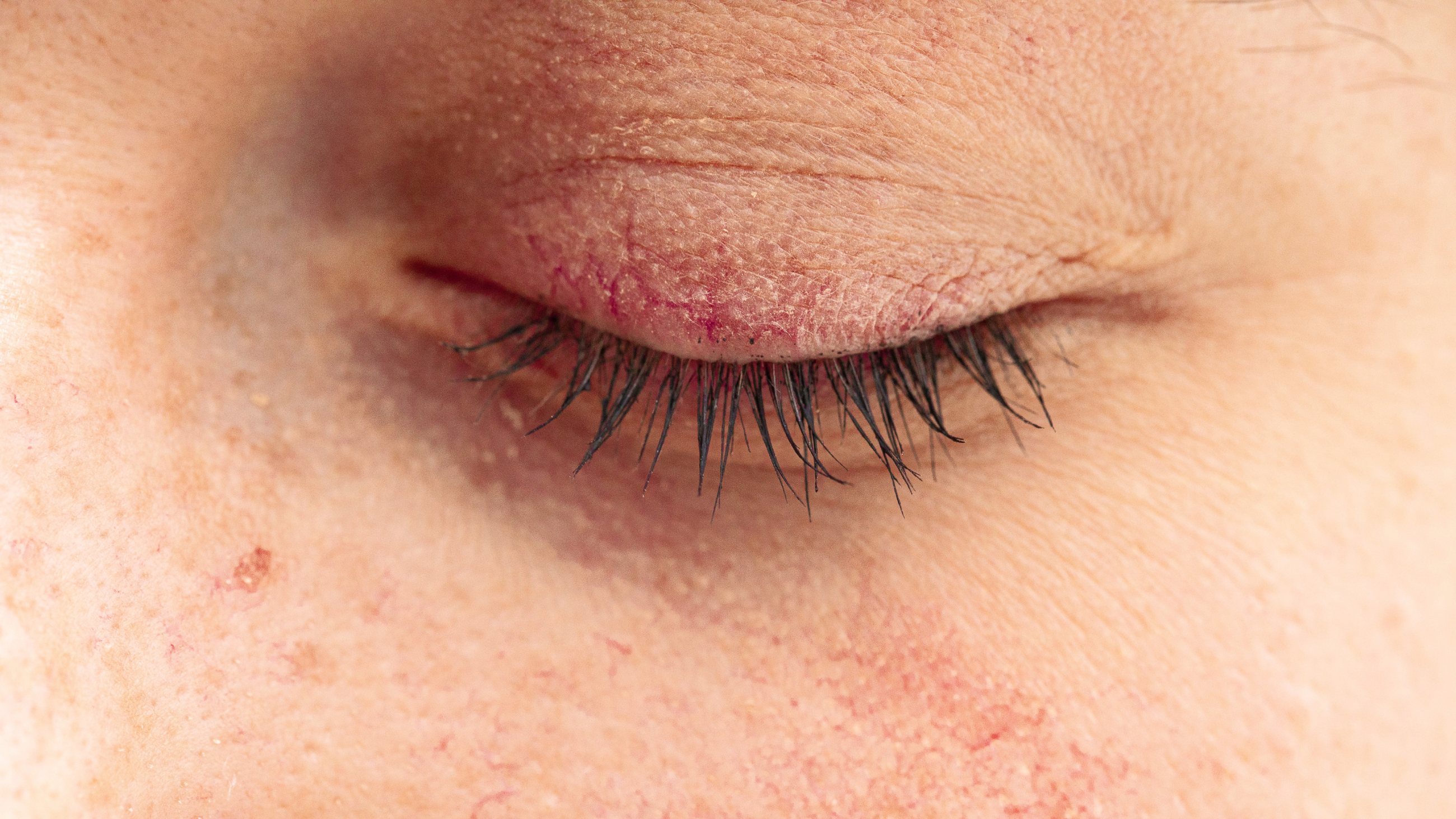 closeup of eyelid dermatitis