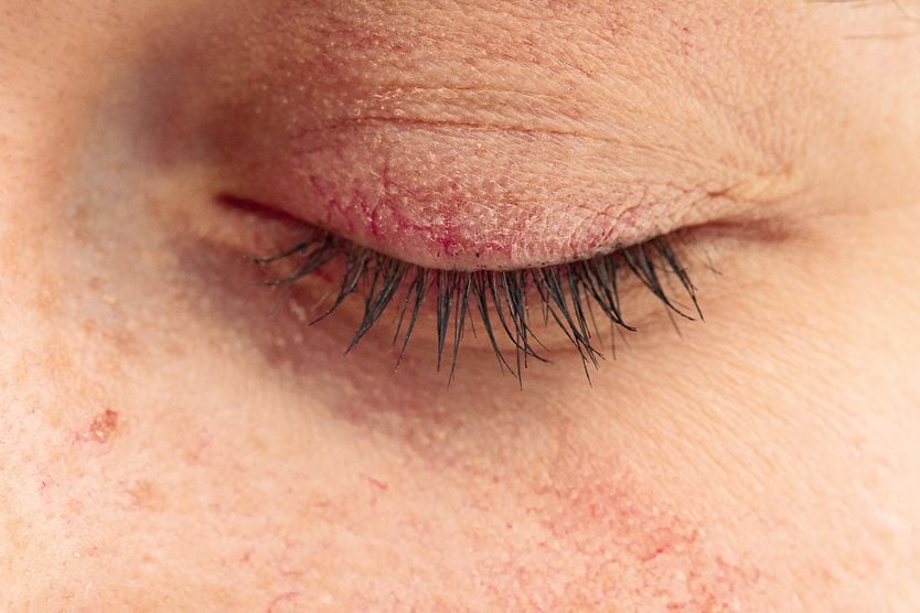 Eyelid dermatitis (eczema): Symptoms, causes and treatment closeup of eyelid dermatitis