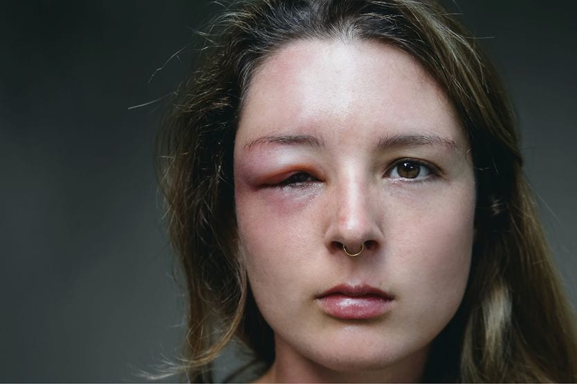 What is orbital cellulitis? woman with orbital cellulitis