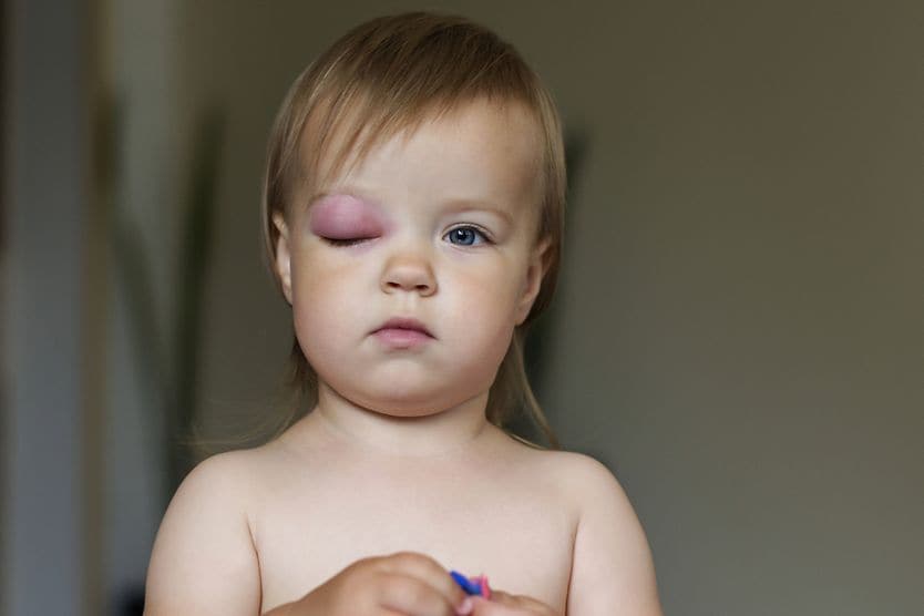 Periorbital cellulitis: Symptoms, causes and treatment child with one swollen eyelid called periorbital cellulitis