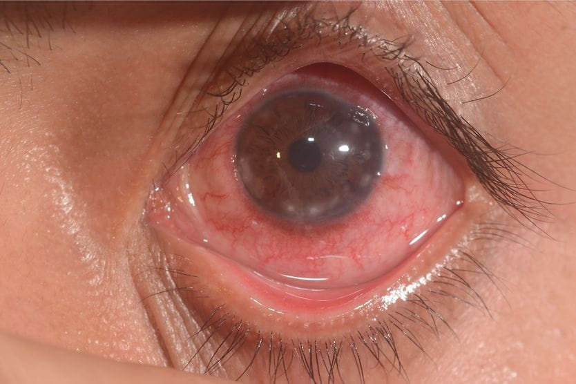 Atopic Keratoconjunctivitis