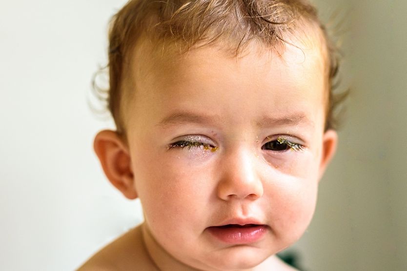 Young toddler with swollen, crusted eyes from conjunctivitis
