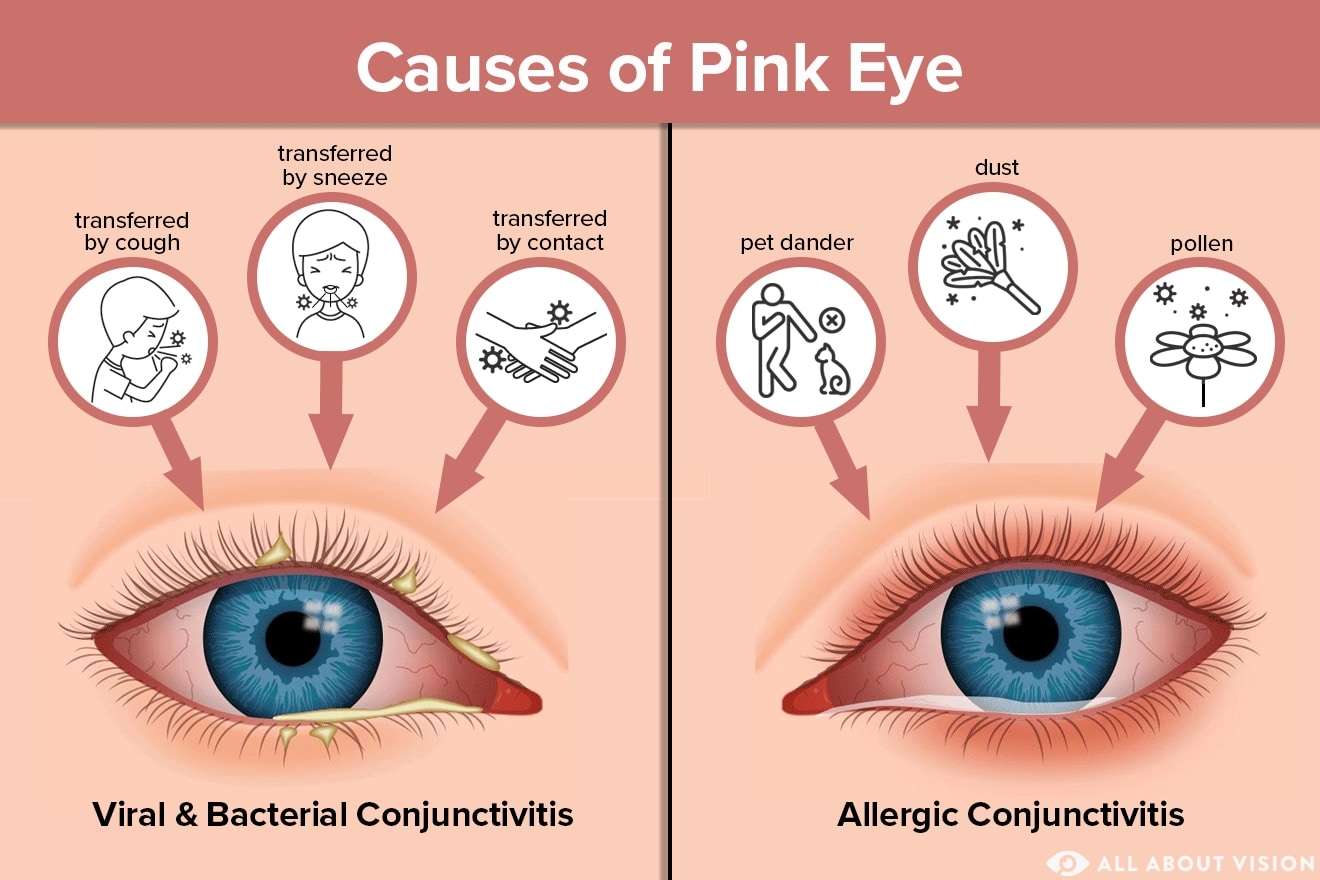 What causes pink eye (conjunctivitis)?
