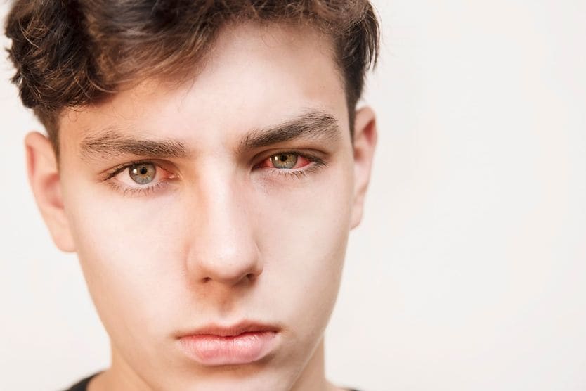 teen boy with chlamydial conjunctivitis