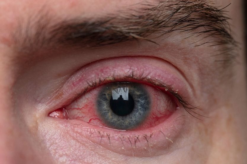 Chronic pink eye (chronic conjunctivitis) Close up of eye with conjunctivitis
