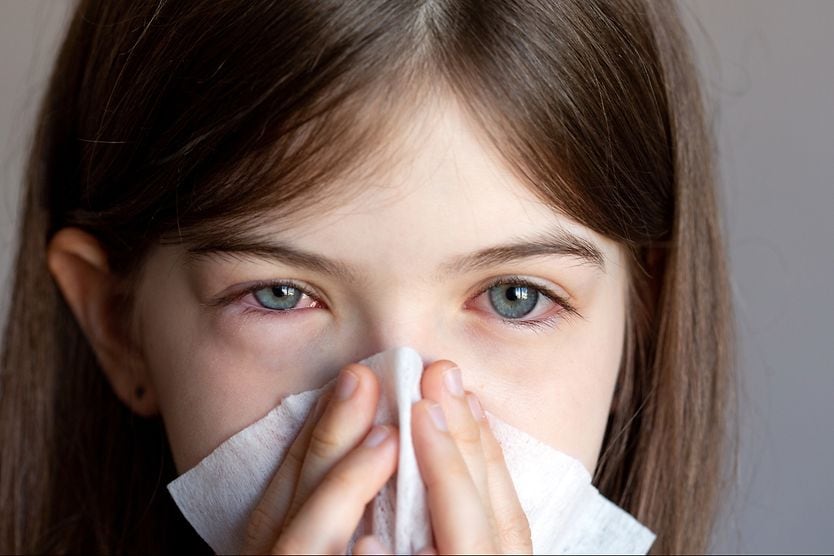 Eye colds: Are they “pink eye” or something else? Girl with pink eyes and a cold