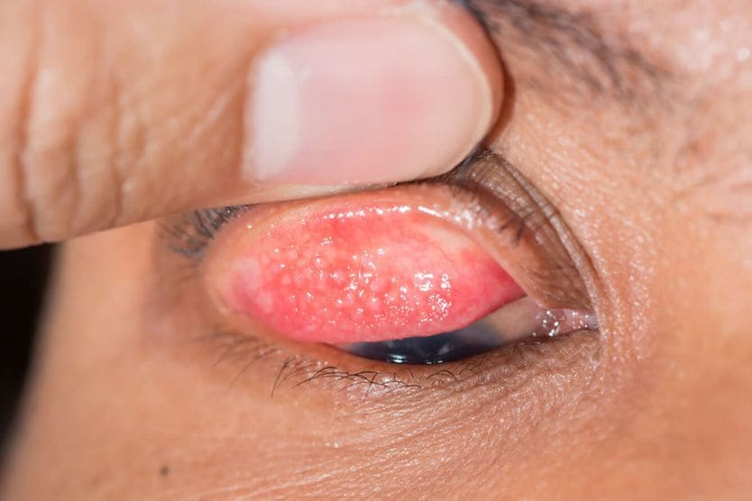 What is follicular conjunctivitis? close up of follicular conjunctivitis during eye examination