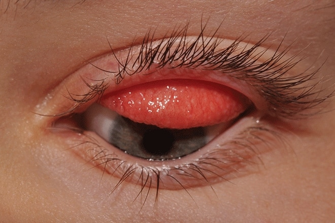 Giant papillary conjunctivitis: Causes, symptoms and treatment Giant papillary conjunctivitis: Causes, symptoms and treatment