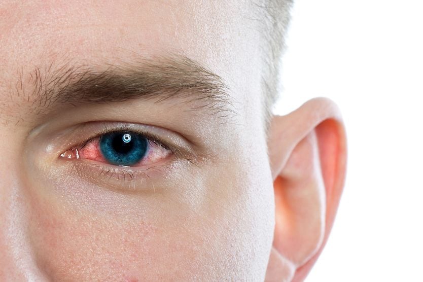 Can you get gonorrhea in the eye? Person with pink eye infection.