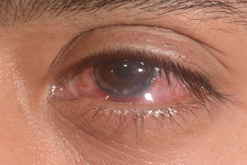 Keratoconjunctivitis close up of eye