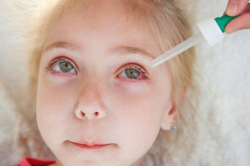 Signs and treatment for conjunctivitis in children Little girl with pink eye receiving eye drops