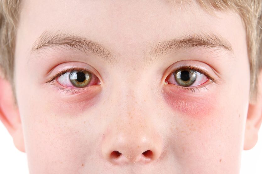 young boy with pink eye