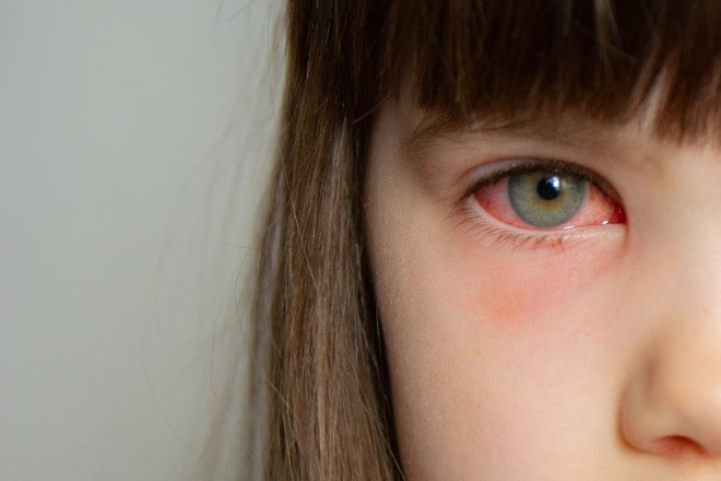 Symptoms of pink eye based on type of conjunctivitis